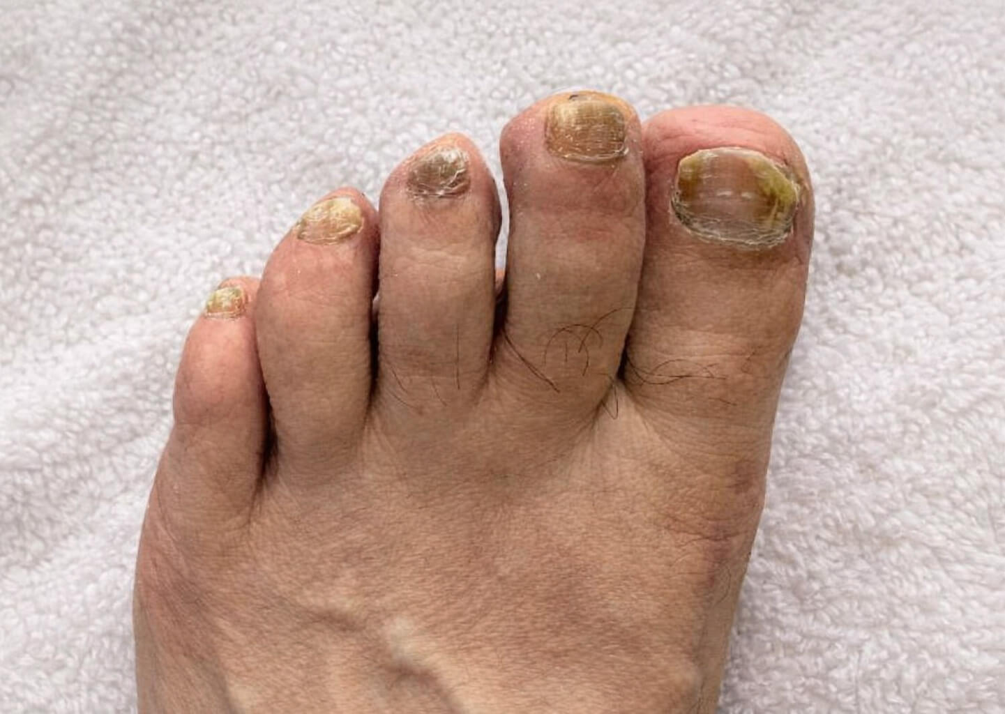 Fungal Nail Treatment Before