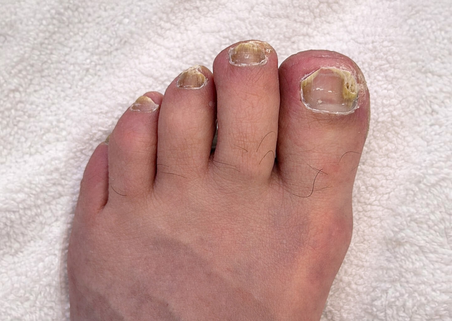 Fungal Nail Treatment Improvement
