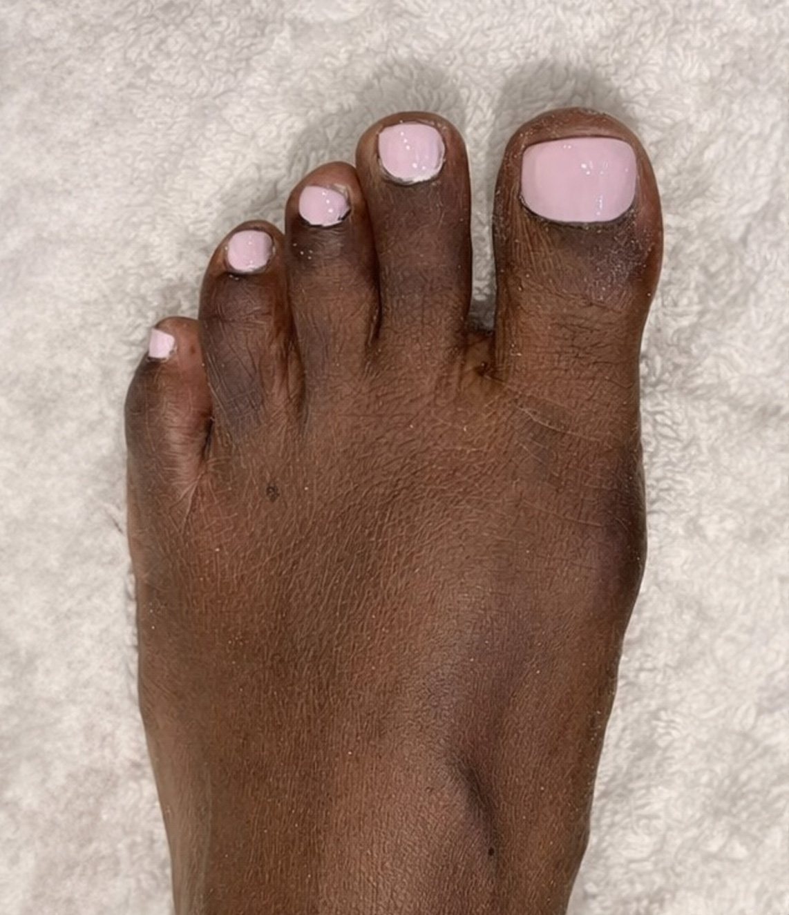 Toenail Reconstruction Treatment After