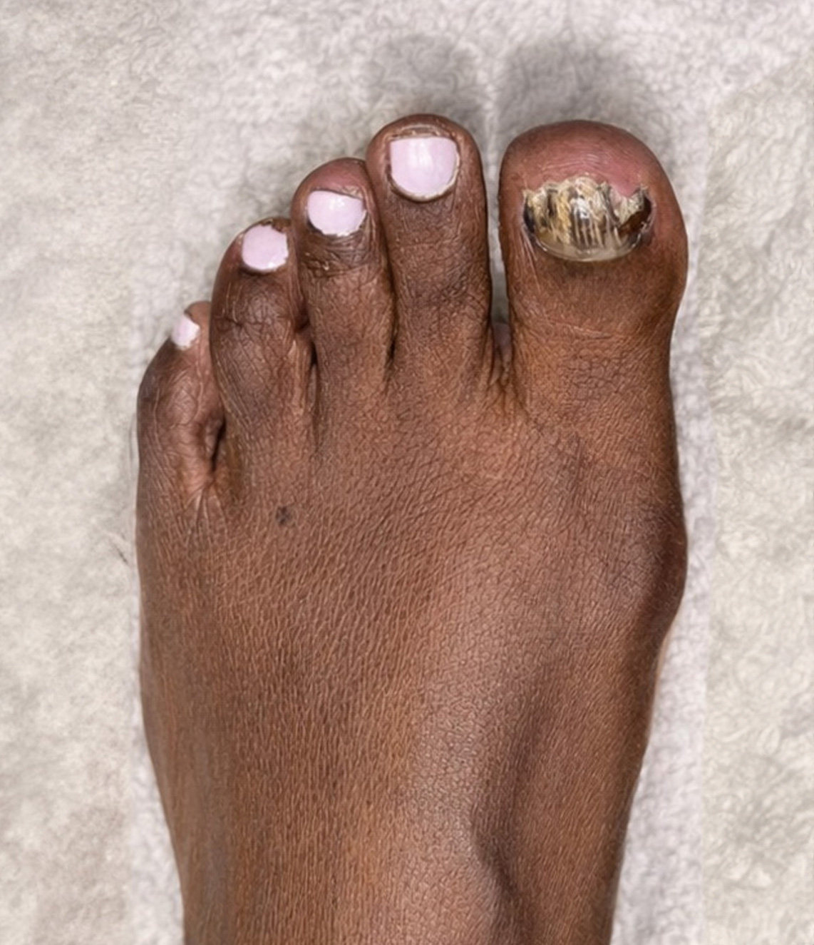 Toenail Reconstruction Treatment Before