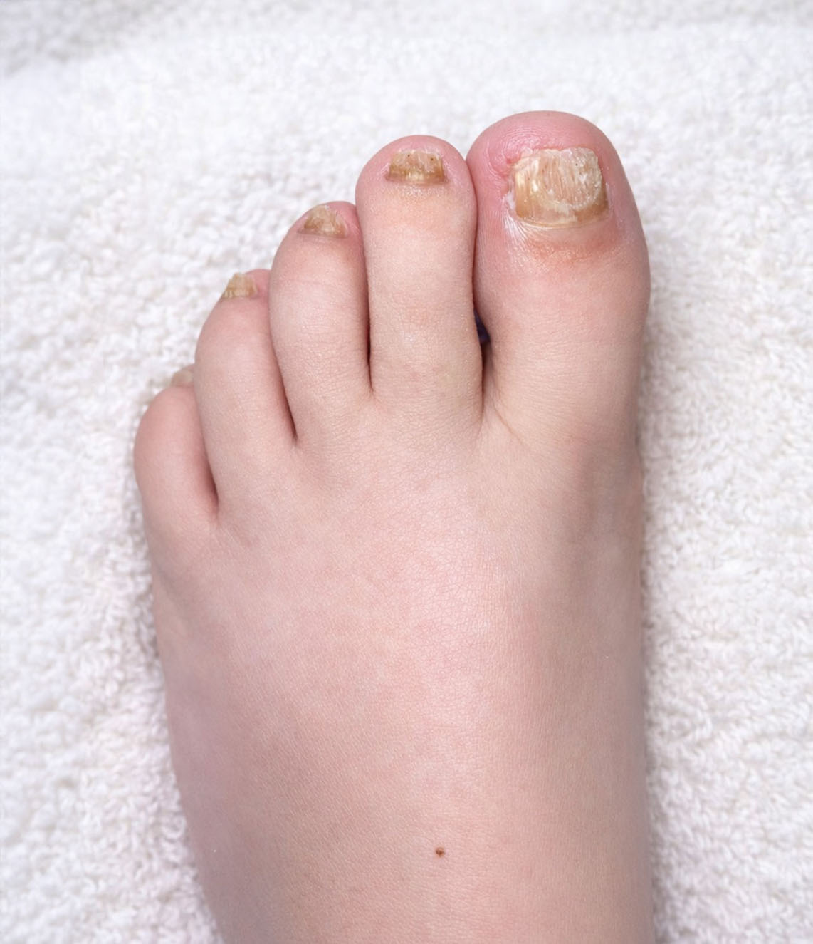 Toenail Reconstruction Treatment Before