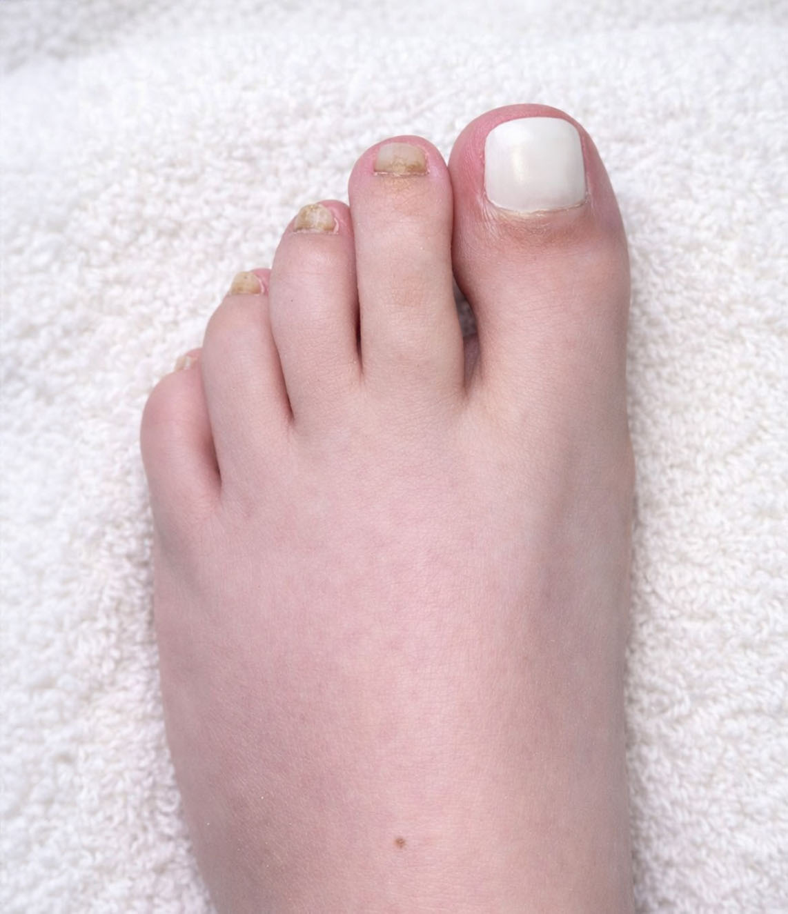 Toenail Reconstruction Treatment During