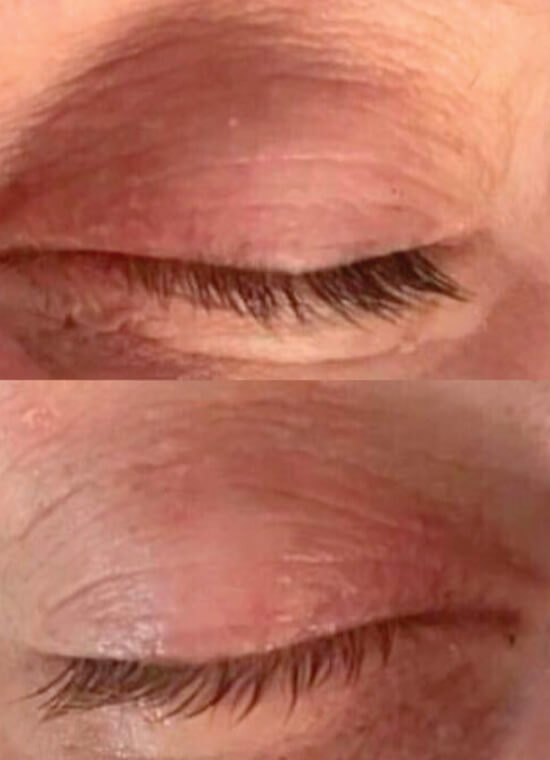 CryoPen Skin Tag Treatment After CryoPen Skin Tag Treatment After