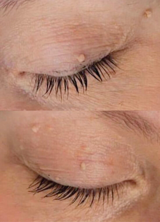 CryoPen Skin Tag Treatment Before CryoPen Skin Tag Treatment Before