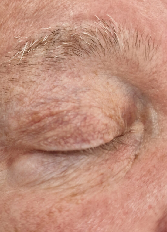 CryoPen Skin Tag Treatment After CryoPen Skin Tag Treatment After