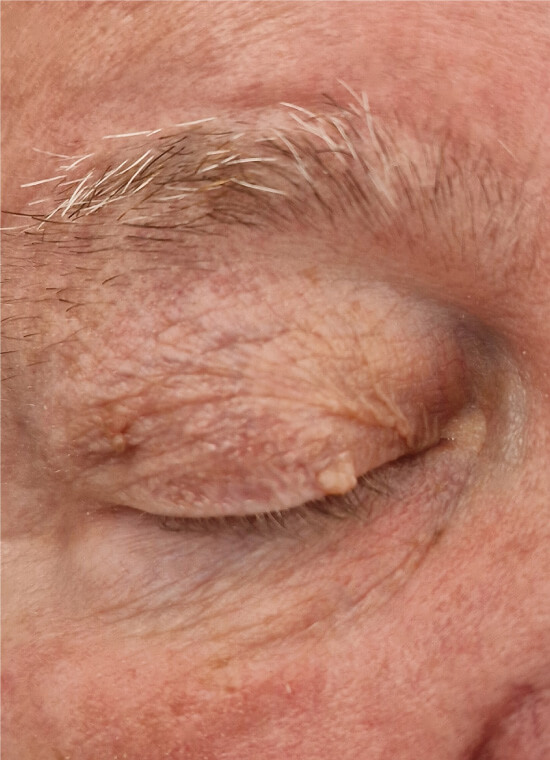 CryoPen Skin Tag Treatment Before CryoPen Skin Tag Treatment Before