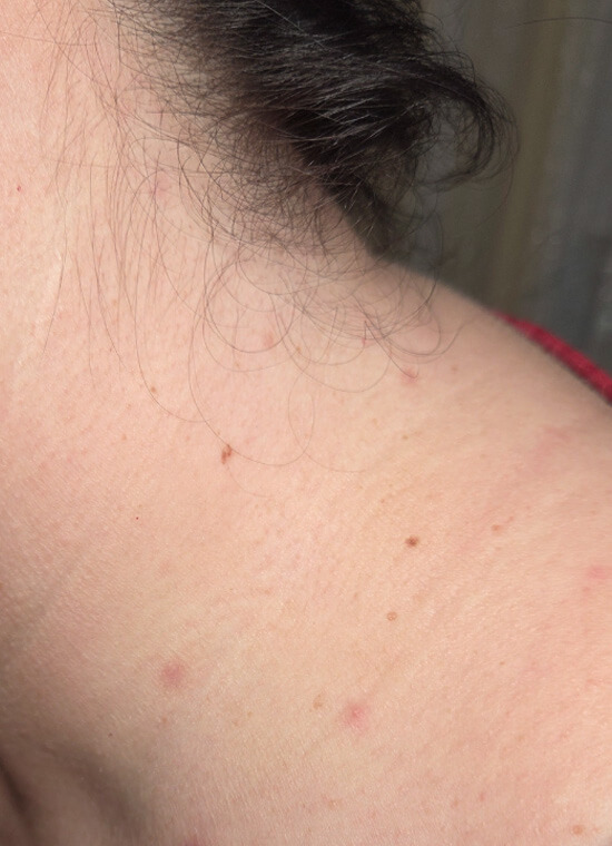 CryoPen Skin Tag Treatment After CryoPen Skin Tag Treatment After
