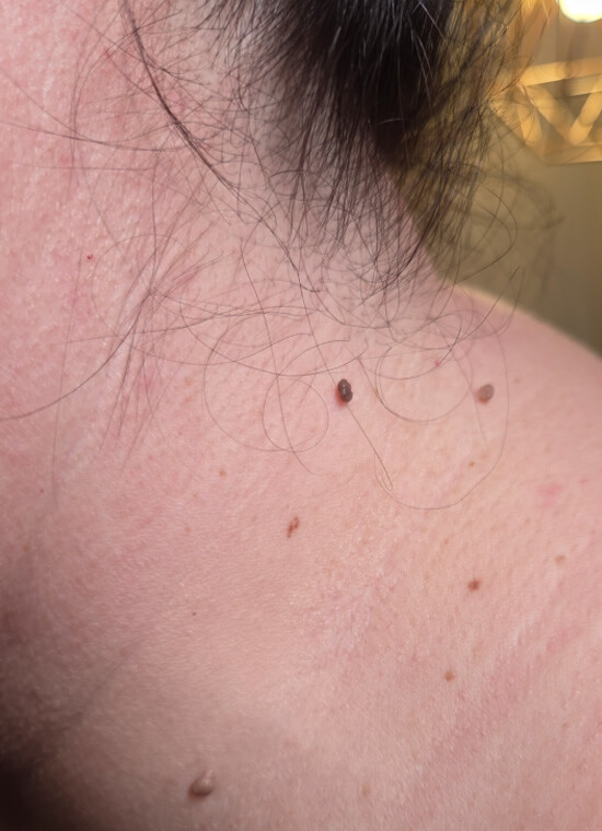 CryoPen Skin Tag Treatment Before CryoPen Skin Tag Treatment Before