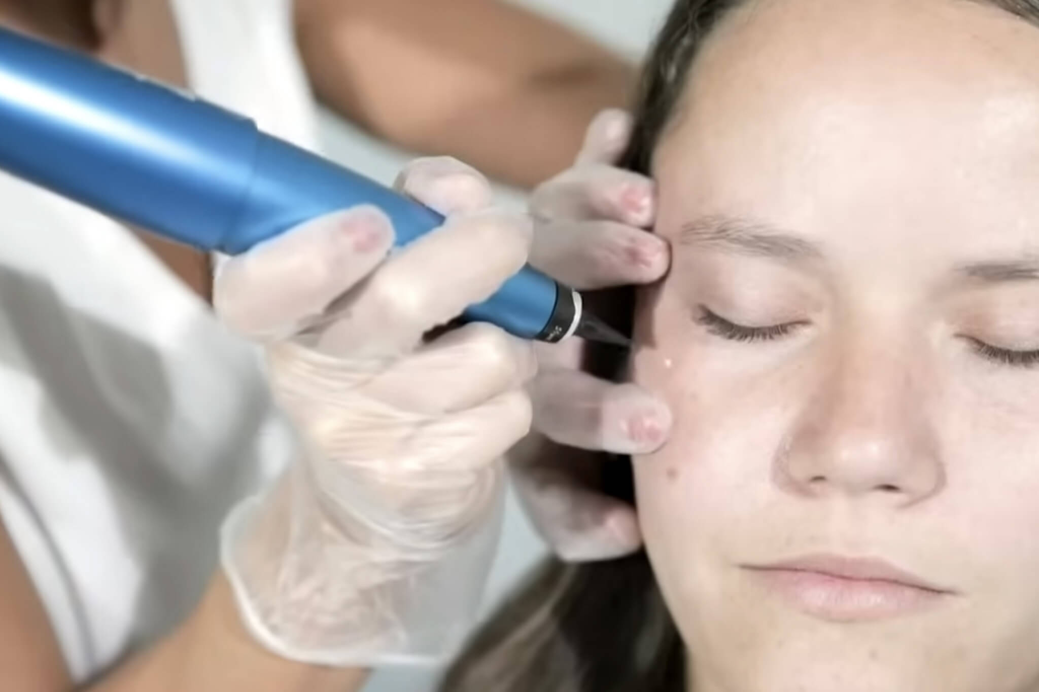 CryoPen Skin Tag & Wart Removal