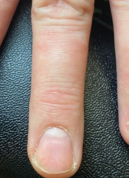 CryoPen Wart Treatment After CryoPen Wart Treatment After