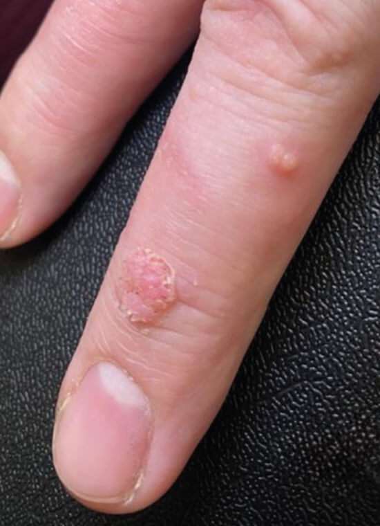 CryoPen Wart Treatment Before CryoPen Wart Treatment Before